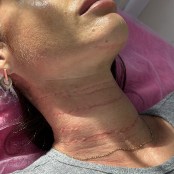 Збільшення губ
                    Косметолог Татьяна Вінниця