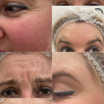 Ботулінотерапія
                    Косметолог-инъекционист Наталья Днепр