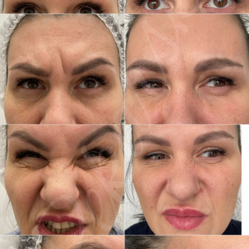 Ботулінотерапія
                    Косметолог-инъекционист Наталья Днепр