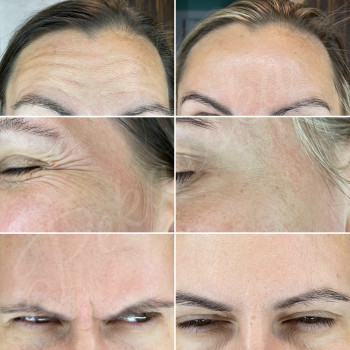 Ботулінотерапія
                    Косметолог-инъекционист Наталья Днепр