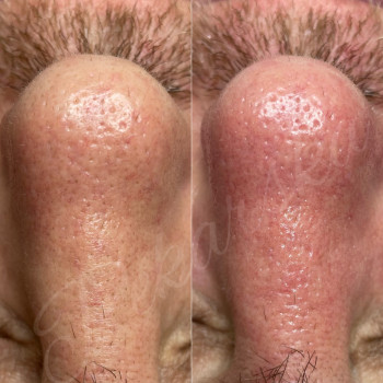 Чистка обличчя
                    Косметолог-ін'єкціоніст Наталья Дніпро