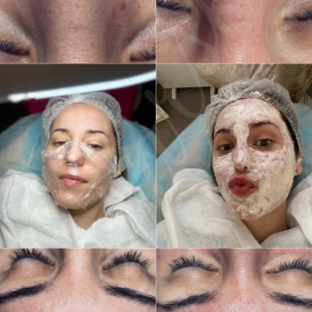 Чистка обличчя
                    Косметолог-ін'єкціоніст Наталья Дніпро