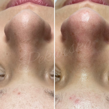 Чистка обличчя
                    Косметолог-ін'єкціоніст Наталья Дніпро