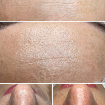 Чистка обличчя
                    Косметолог-ін'єкціоніст Наталья Дніпро