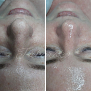 Чистка обличчя
                    Косметолог-ін'єкціоніст Наталья Дніпро