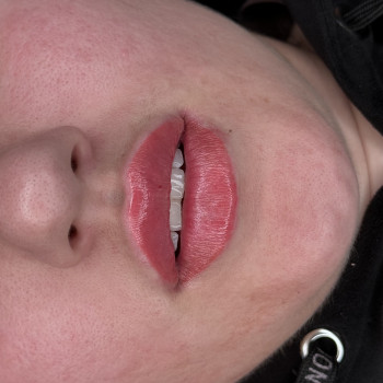 Збільшення губ 1мл