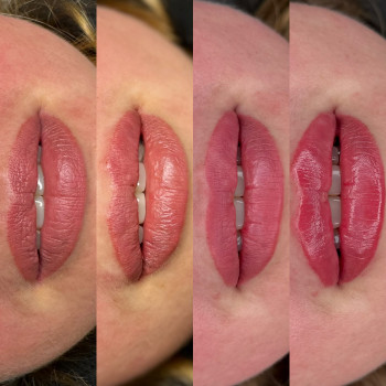 1мл філера введення за два рази