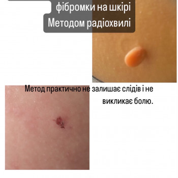  #радіохвильовевидаленняльвів #папіломильвів #радіоніжльвів
