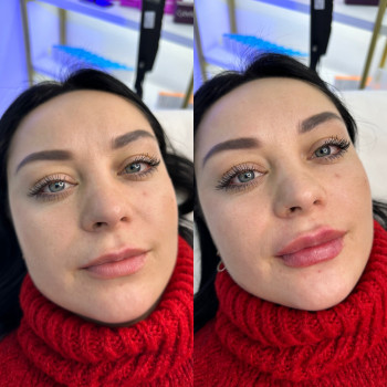 Збільшення губ
                    Косметолог Татьяна Вінниця