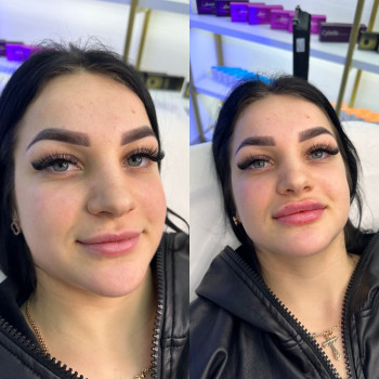 Збільшення губ
                    Косметолог Татьяна Вінниця