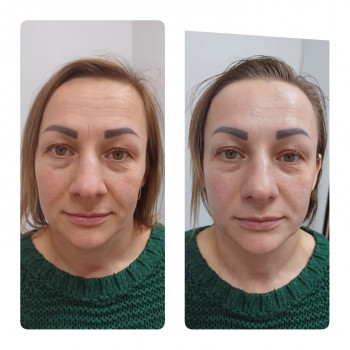 Буккальний масаж
                    Косметолог Інга Хмельницкий