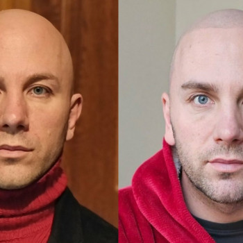 фото до та після 3 процедур. буде ще одна.