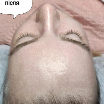 Карбоксітерапія