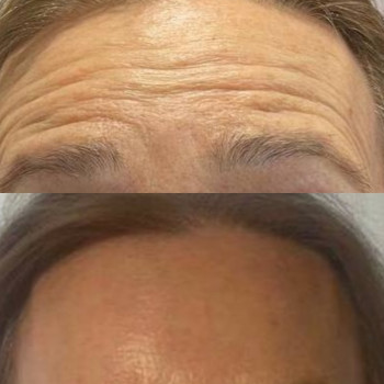 Ботулінотерапія