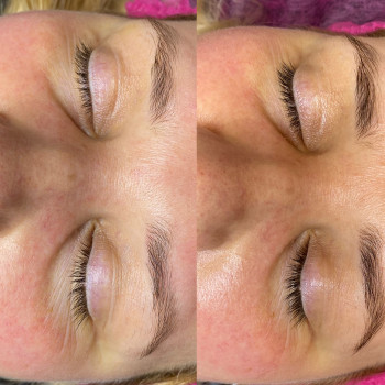 Робота з переорбітальною зоною ( препарат Hydro PLLA)