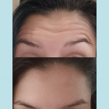 Корекція мімічних зморшок за допомогою ботулотоксину.