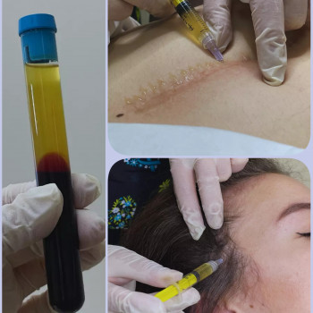 Плазмотерапія.