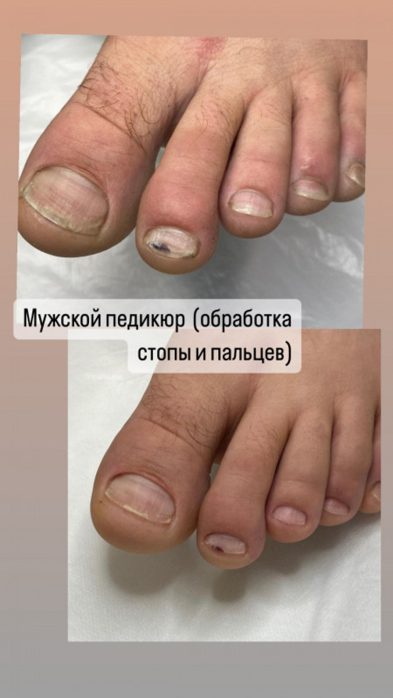 Подолог травма ногтя, фото - Мастер маникюра Наталья Балаховская