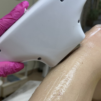 Лазерная эпиляция; лазерна епіляція
                    Мастер эпиляции Янітта Киев