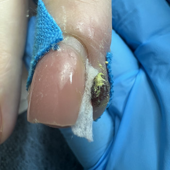 Врослий ніготь
 
 
 
 