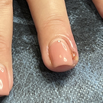 Врослий ніготь

 
 
 