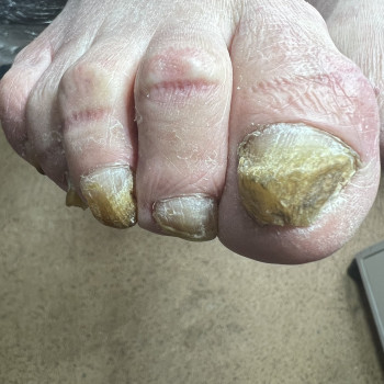 Оніхогрифоз

 
 
 