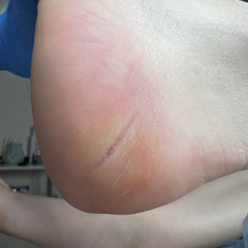 Тріщіни
Врослій ніготь

 
 
 