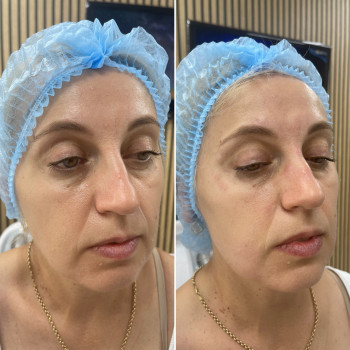 ✅Smas lifting ULTRAFORMERlll

❌ без болю
❌ без реабілітаційного періоду
ℹ️ повний ефект після процед...