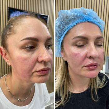 SMAS-ліфтинг Ultraformer
                    Косметолог Ксения Кропивницкий