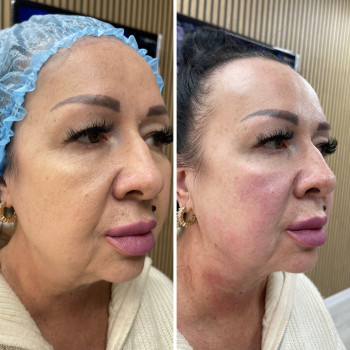 SMAS-ліфтинг Ultraformer
                    Косметолог Ксения Кропивницкий