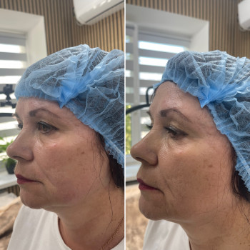 ✅Smas lifting на апараті ULTRAFORMER нижньої третини обличчя,фото до та після процедури повний ефект...