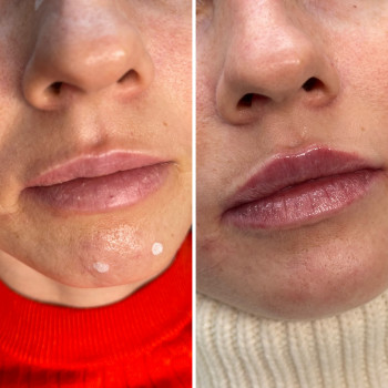 Контурная пластика губ
                    Косметолог Ксения Кропивницкий