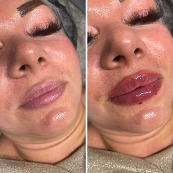 Контурная пластика губ
                    Косметолог Ксения Кропивницкий