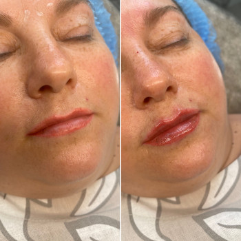 Контурная пластика губ
                    Косметолог Ксения Кропивницкий