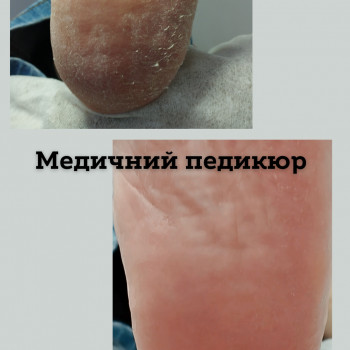 чистка пятки, медицинский педикюр