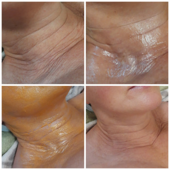  
До и после 1 процедури