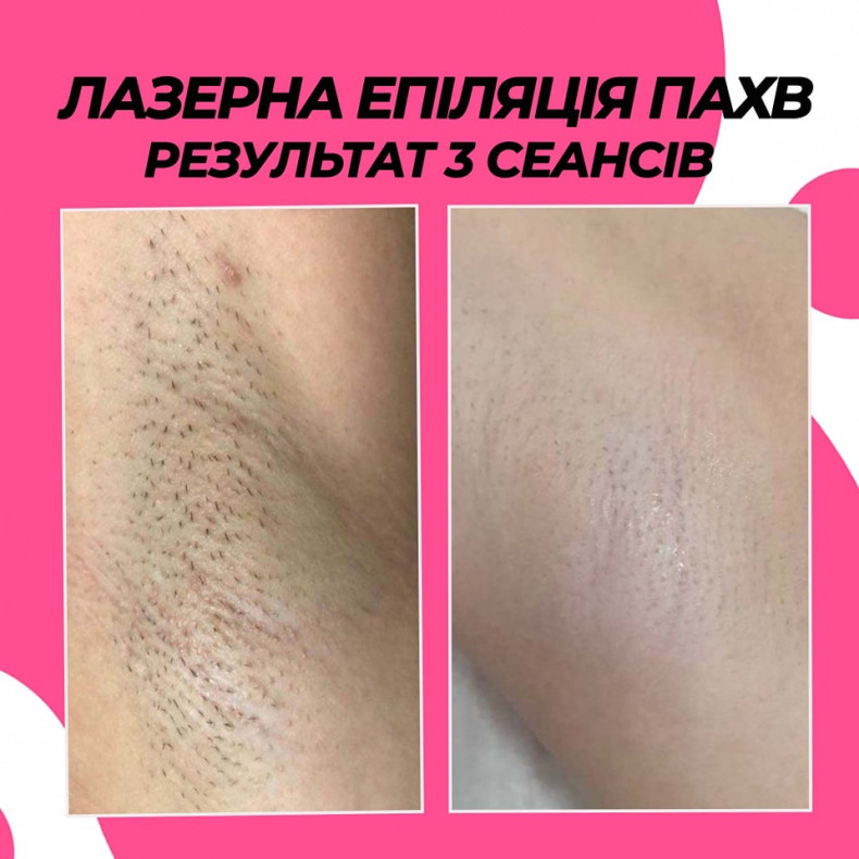Лазерна епіляція пахв діодний лазер  #лазернаепіляція #лазернаепіляціяпахв #епіляціяпахв #епіляція, фото -  