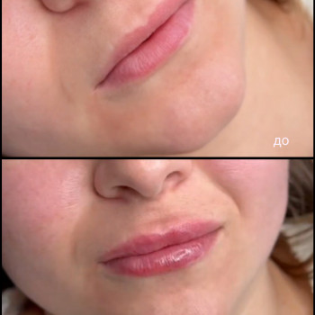 Контурна пластика губ