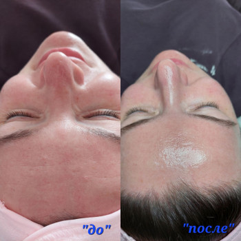 Ультразвукове чищення
                    Косметолог-естетист Марина Одеса