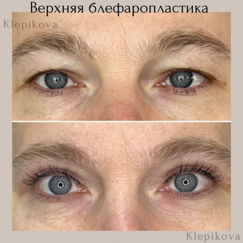 Верхняя блефаропластика, 2 мес, фото -  