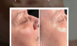 Ферментативний ліфтинг Косметолог-ін'єкціоніст Татьяна Мукачево