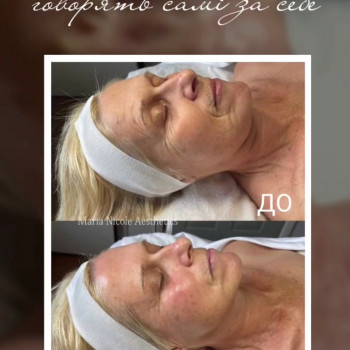 Результат одразу після процедури