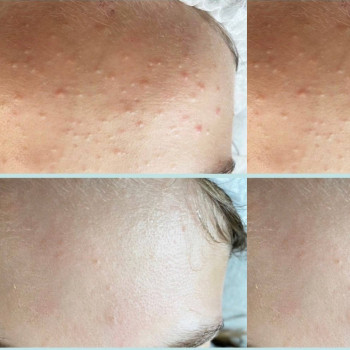 Ультразвукове чищення
                    Косметолог-естетист Марина Одеса