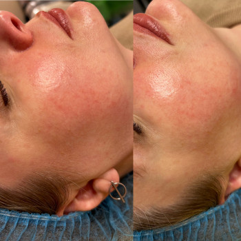 1 процедура еритематозної розацеа