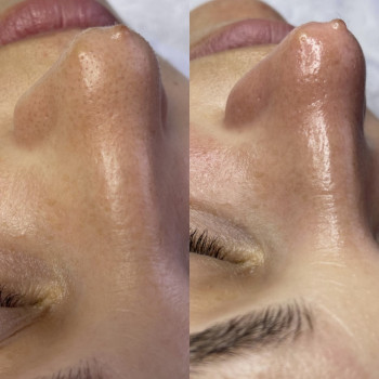 Чистка обличчя
                    Косметолог Лілія Николаев