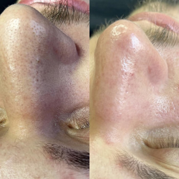 Чистка обличчя
                    Косметолог Лілія Николаев