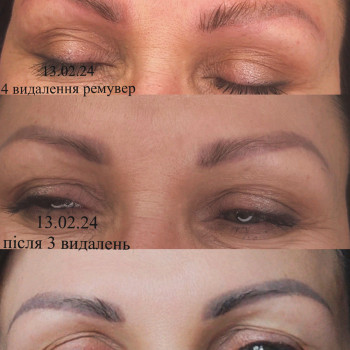 Видалення татуажу, перманенту лазер/ремувер
                    Мастер перманентного макияжа Тетяна Киев