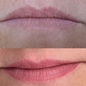 1 сеанс лазерного видалення