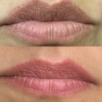 Заступ за контур -1 сеанс видалення