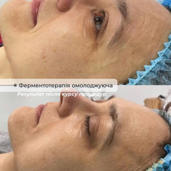 уход за лицом, коррекция морщин, косметология лица
